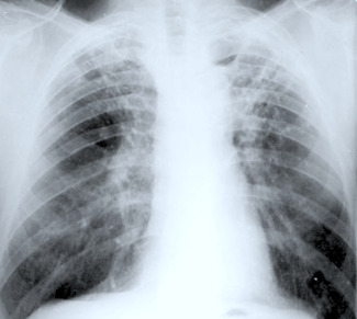 Tuberculosis recurrence and its associated risk factors