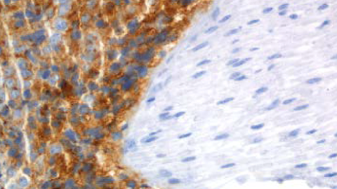 Sobreexpressió de receptor CXCR4 a la medul·la òssia