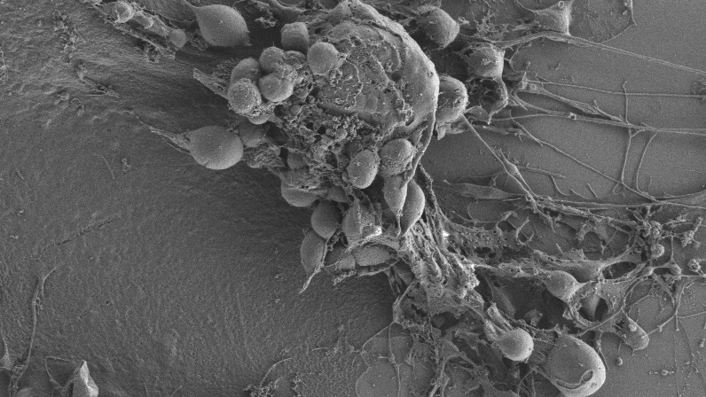 Glioblastoma