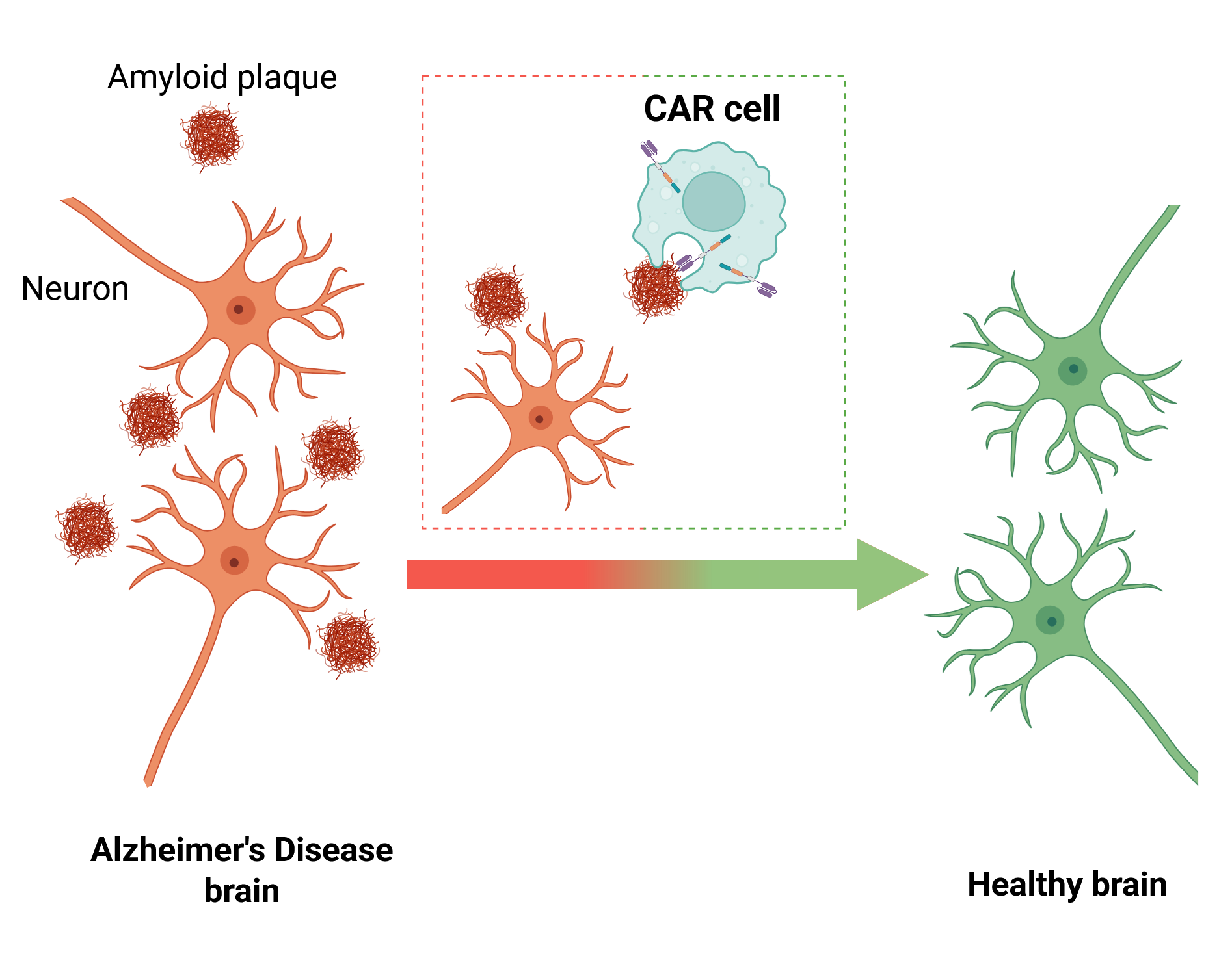 Gràfic il·lustratiu de l'actuació d'immunoteràpies CAR sobre agregats amiloides. © IBB-UAB.
