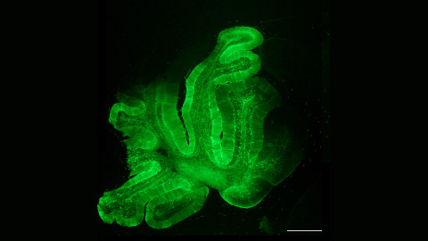 Teràpia gènica per al tractament de la leucoencefalopatia megaloencefàlica 