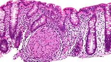 Identifiquen compostos químics com a possibles inductors de malalties inflamatòries intestinals